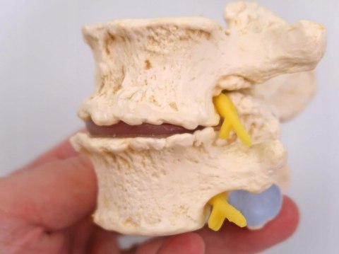 NAUKOWY MODEL ANATOMICZNY 3B SCIENTIFIC A795 ZWYRODNIENIE KREGÓW
